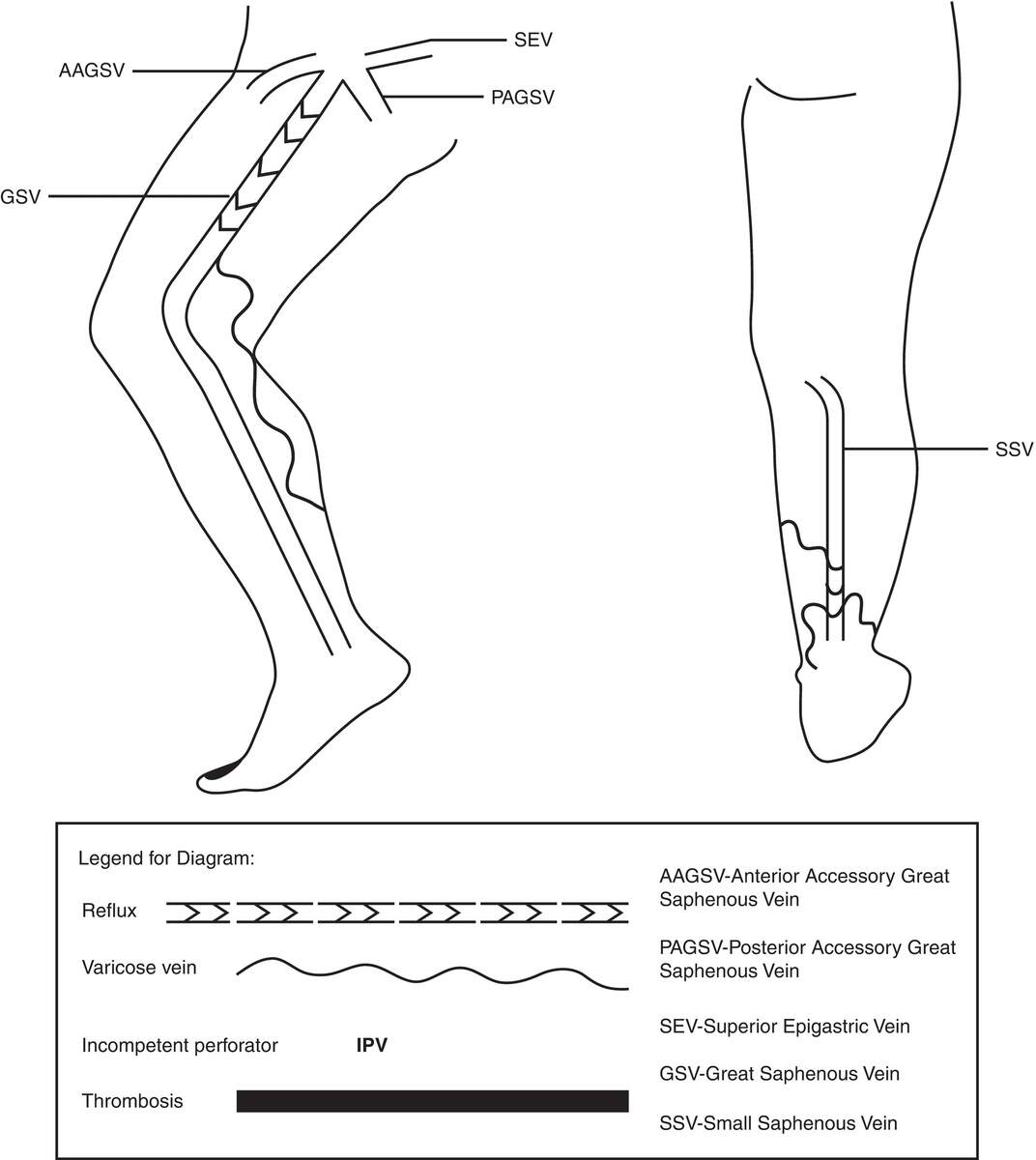 Chronic Venous Disorders Thoracic Key